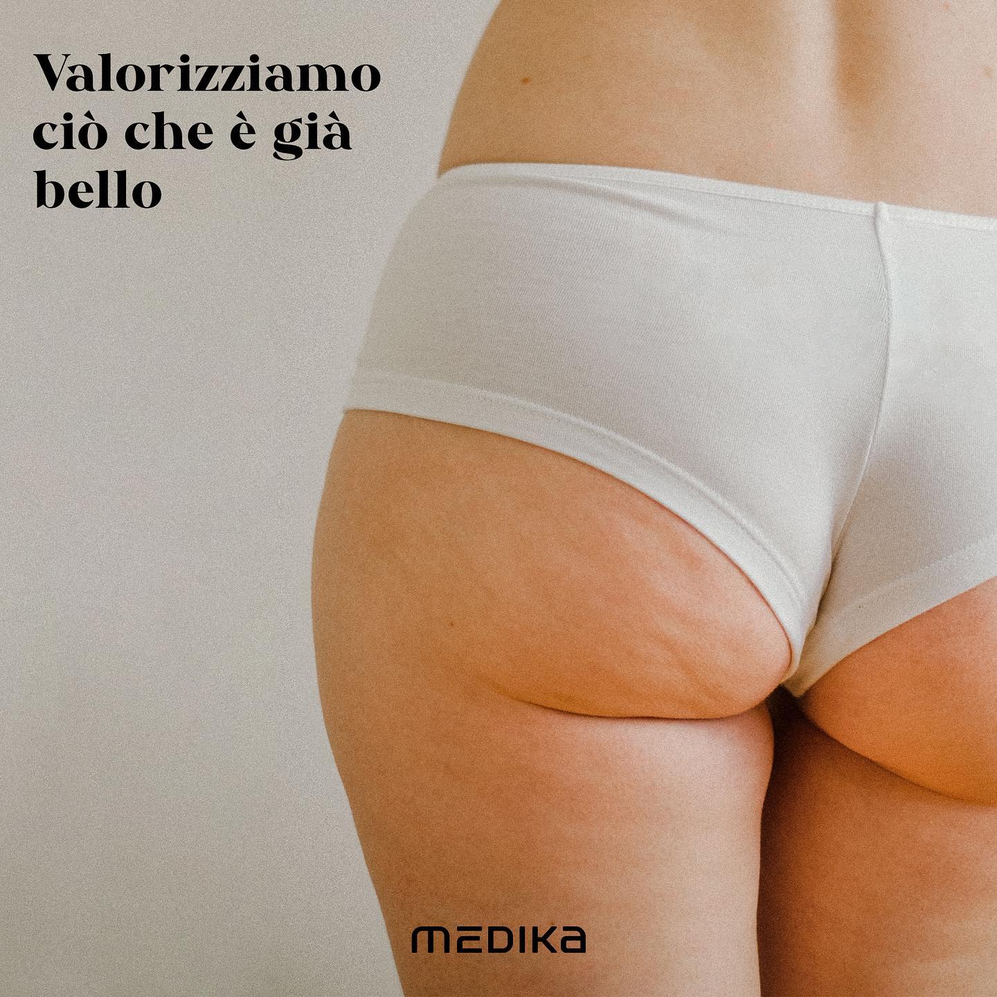 Trattamento Smagliature bianche